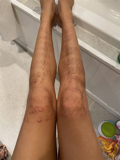 Impressive Info About How To Get Rid Of Laser Burn - Studyyear11