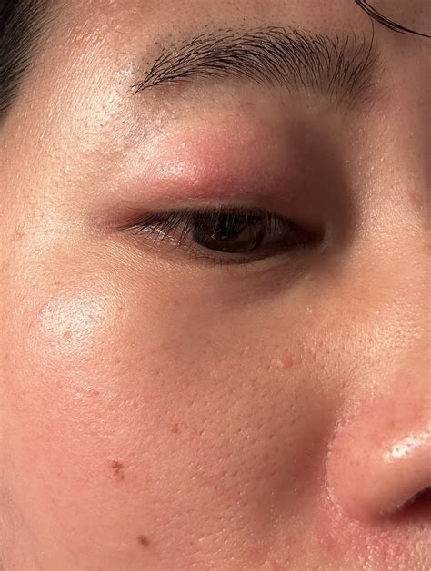 Bug Bite On Eyelid