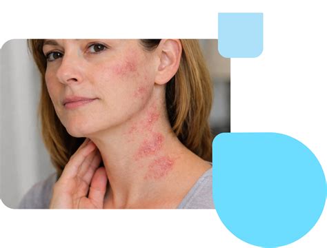 Shingles Treatment Online | Derms 24 Hrs - Miiskin