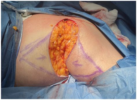 Suppurativa Hidradenitis Surgery