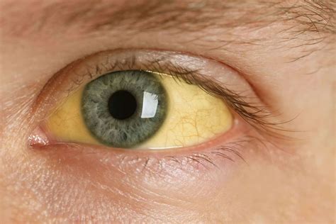 5 enfermedades que podrían detectarse a través de los ojos - Dirmedal ...