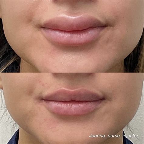 When Lip Filler Goes Bad: Can You Dissolve Lip Filler? - Utah Facial Plastics