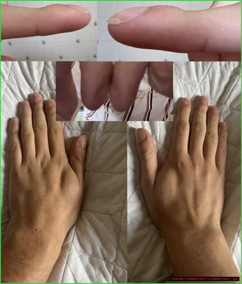 Jeremy Renner's Clubbed Fingers: A Deep Dive Into His Condition And ...