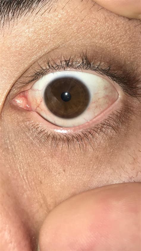 Do for your I have yellow eyes? Or it’s normal color? : r/optometry