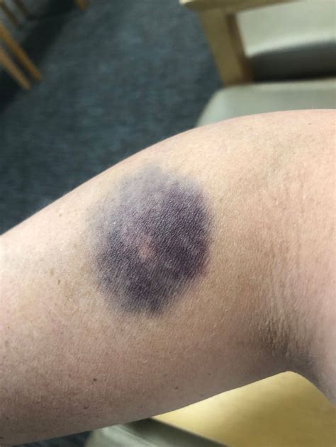 Anemic Bruise