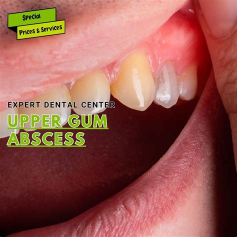 What is an Upper Gum Abscess?