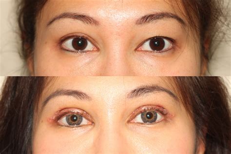 Double Eyelid Surgery