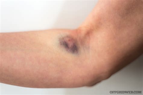 The Basics of IV Fluids for Emergency Scenarios | RECOIL OFFGRID