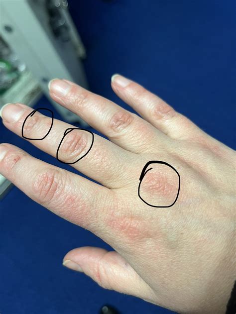 Hot knuckles/finger joints : r/PsoriaticArthritis