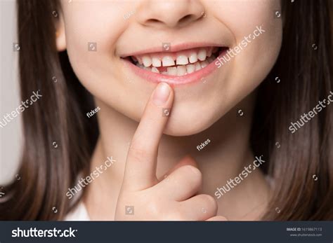 86 6 Year Old Molars Royalty-Free Images, Stock Photos & Pictures ...