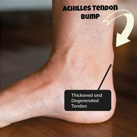 Achilles Tendonitis | Treatment for Heel Pain and Symptoms | Alleviate ...