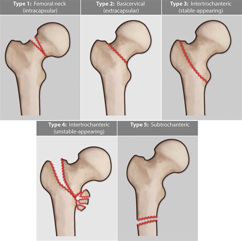 Femoral neck fracture causes, types, symptoms, diagnosis, treatment ...