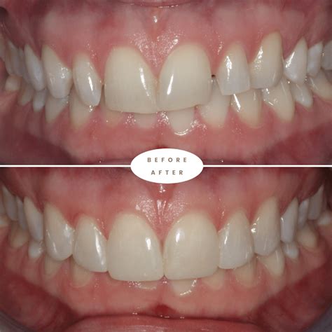 Composite Bonding in Sydney | Composite & Dental Bonding