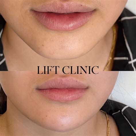 What Does 1ml of Lip Filler Look Like? 1ml Lip Fillers Before and After ...