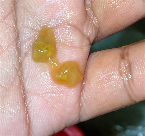 Thick And Sticky Mucus _ Thick Rubbery Mucus Nose – UMRQGO