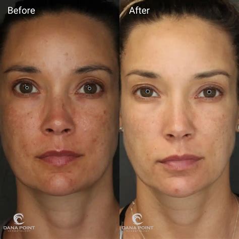 Chemical Peel - Before and After | Dana Point Dermatology