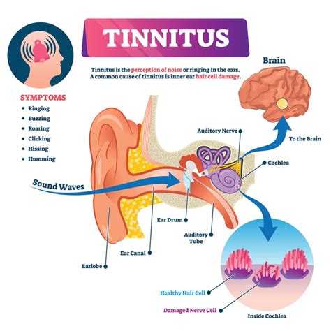 Understanding Tinnitus - Audiology Associates
