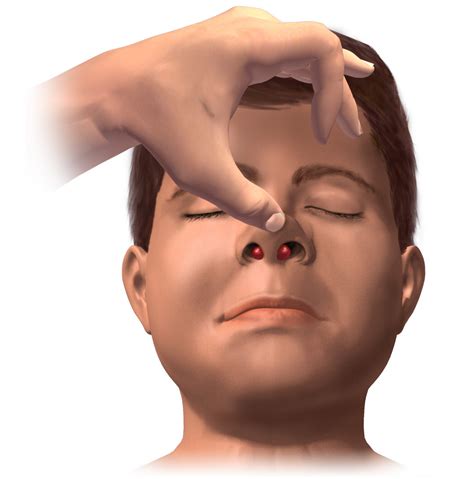 Hematoma do septo nasal – Wikipédia, a enciclopédia livre