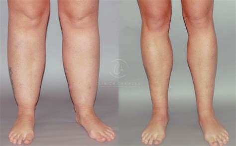 Que Es Lipedema Las Causas