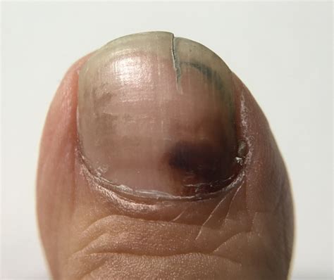 Subungual Hematoma : Causes, Treatments – MWPGLA