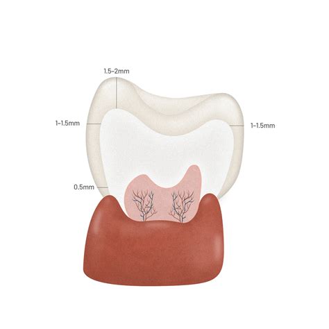 PFM Crown Prep Dimensions | Oceanic Dental
