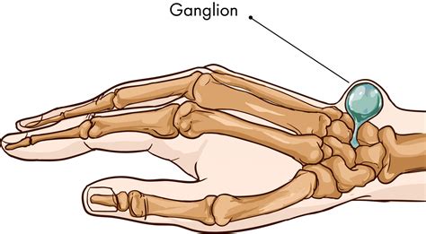 Ganglion Cysts | Montreal, Toronto, Ottawa, Gatineau