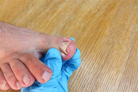 Is Toenail Fungus Contagious? | Credihealth