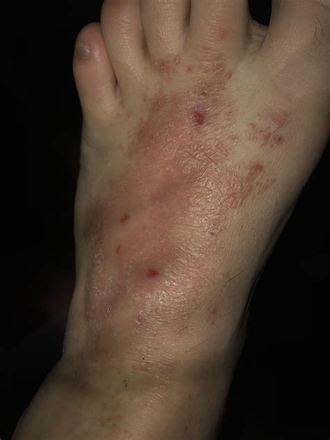 Is this athletes foot? I work 12 hour shifts and and on my feet all ...