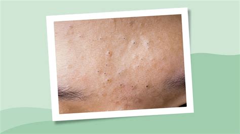 Skin Conditions Resource Center