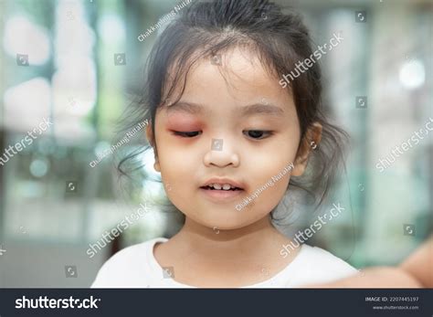 Puffy Eyes On Baby at Kasey Bailey blog