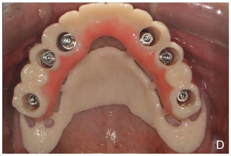Digital Workflow for Edentulous Patients with Implant-Supported Fixed Prostheses: A Fully ...