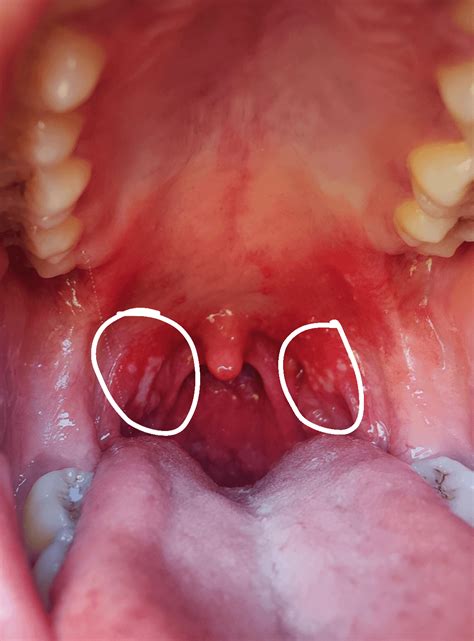 Swollen Tonsils With White Spots Acute Tonsillitis (image 1 Of 2)