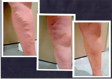 Laser Ablation Wound at Charles Kesteven blog