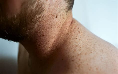 Why Brown Spots On Skin Happen And How To Treat? | Evolve Med Spa