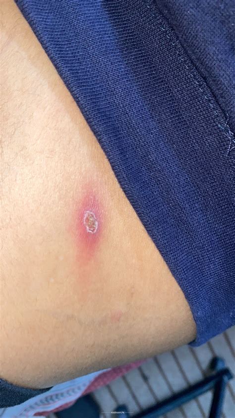 Inflamed Mosquito Bite