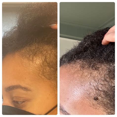 Derma roller for hair growth: How to regrow your edges with at home ...