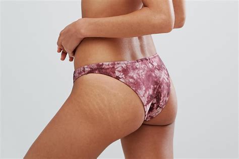 Cause, âge, solution: 5 questions que l'on se pose sur les vergetures