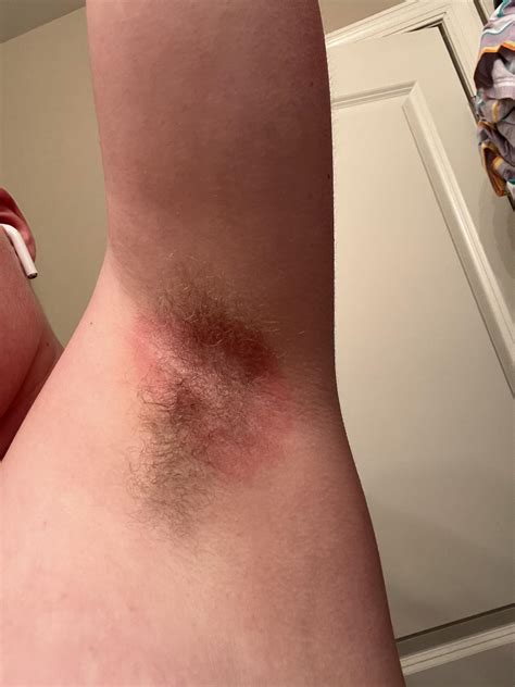 Burns from deodorant or fungal infection in my armpits? Very itchy and burns in a very prickly ...