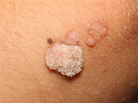 Verruca definition, causes, signs, symptoms, diagnosis & treatment