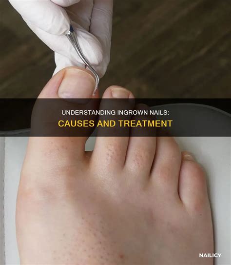 Understanding Ingrown Nails: Causes And Treatment | Nailicy
