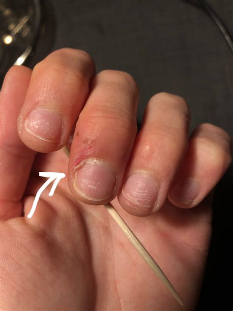 Top layer of my nails grow over the skin which covers my nailbed ...