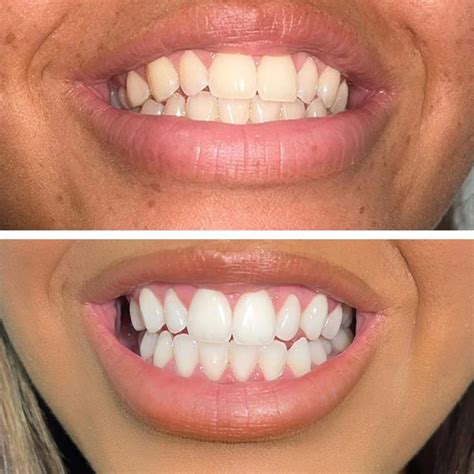 Foaming White Teeth Whitening Review at Loretta Little blog