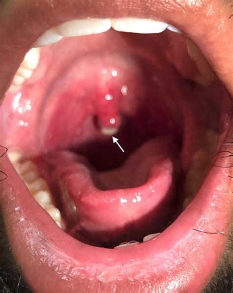 What causes canker sores on your uvula?