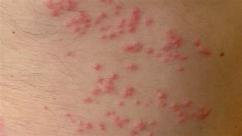 Sea Lice Bites - Jelly Fish Sting - Remedy - Cure - Surfing - South Florida