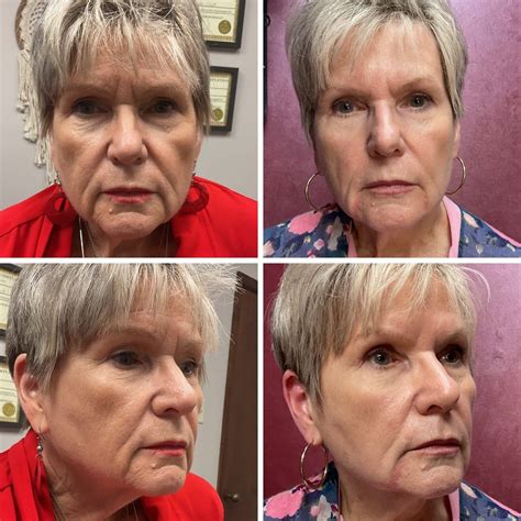 Aesthetics/“botox” — Elevated Aesthetics