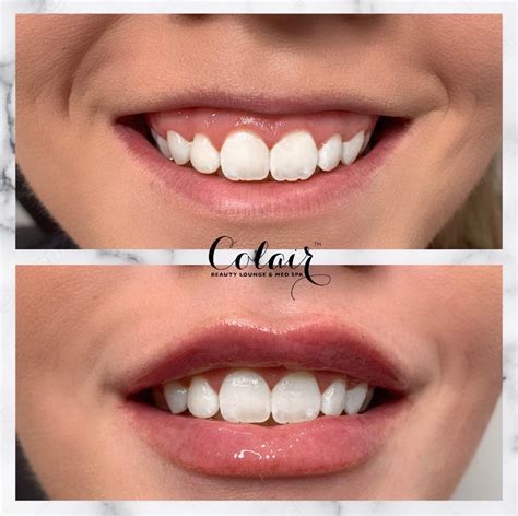 Botox Before And After Smile Lines