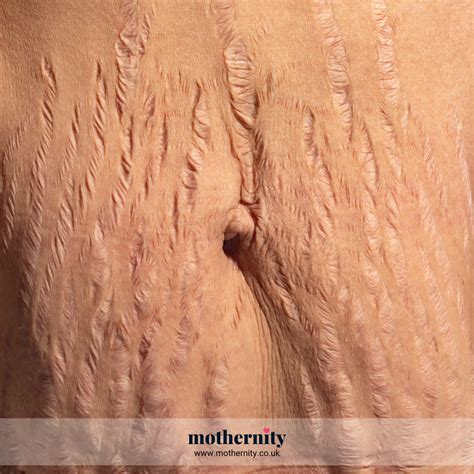 Pregnancy stretch marks - Mothernity