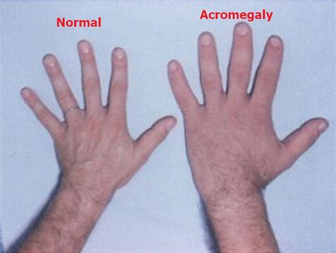 Acromegaly - Gigantism vs Acromegaly - Causes, Symptoms, Treatment