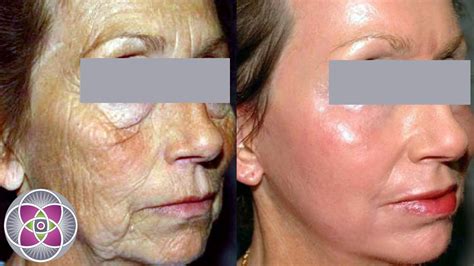 Non Surgical Facelift Before and After | Non surgical facelift, Facelift before and after ...