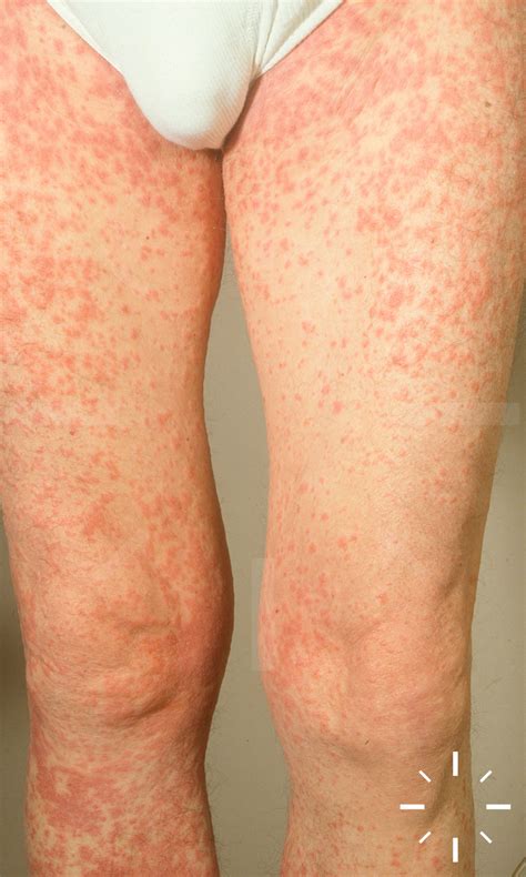 Early Stevens Johnson Syndrome A Case Of Stevens–Johnson Syndrome In